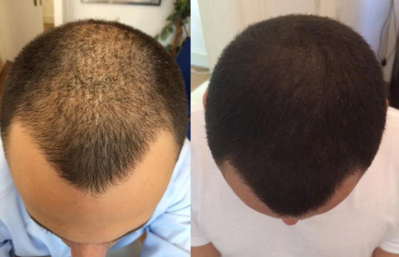 La solución discreta para la pérdida de cabello