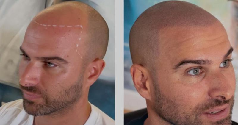 La solución discreta para la pérdida de cabello